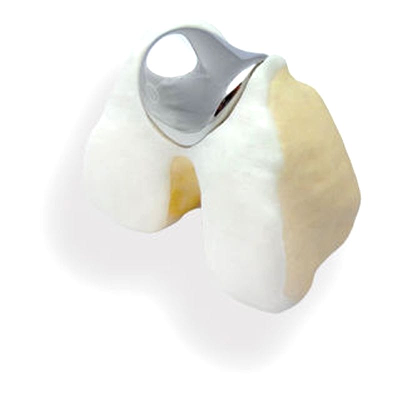 Patello-Femoral Prosthesis