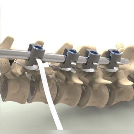 Pediatric Posterior Spinal Fixation Band