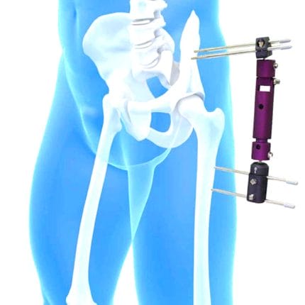 Pelvis External Fixation System 1