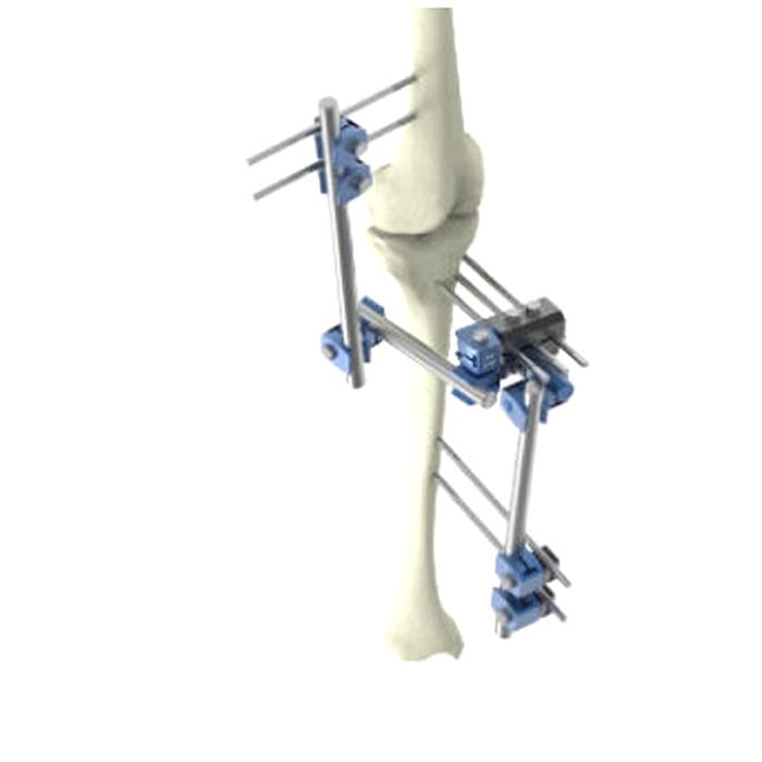 Pelvis External Fixation System 2