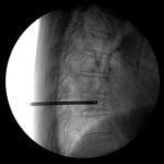 Percutaneous Vertebroplasty Instrument Kit 4