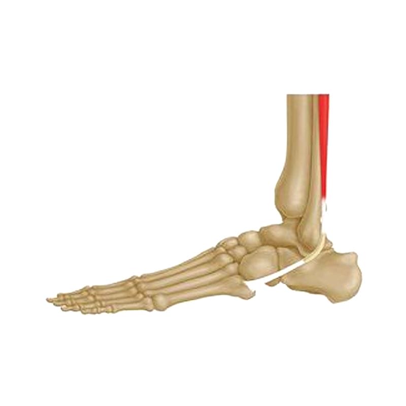 Peroneus Longus Tendon Ligament Prosthesis 1