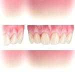 Pmma Dental Prosthesis 4