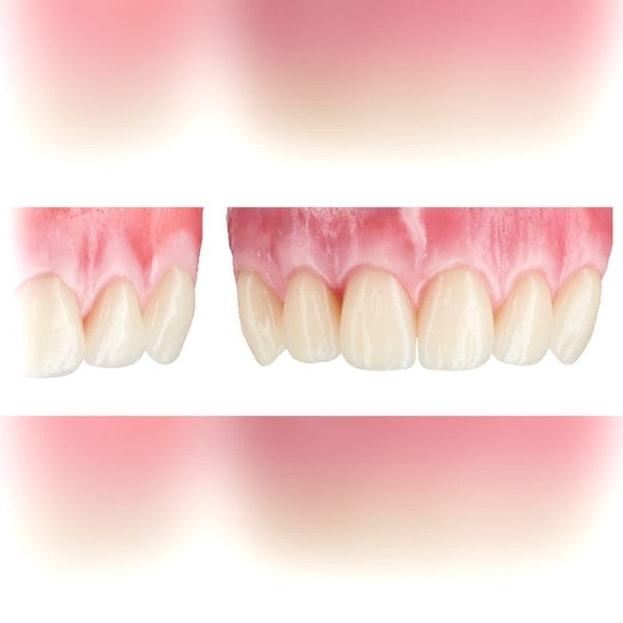 Pmma Dental Prosthesis 4