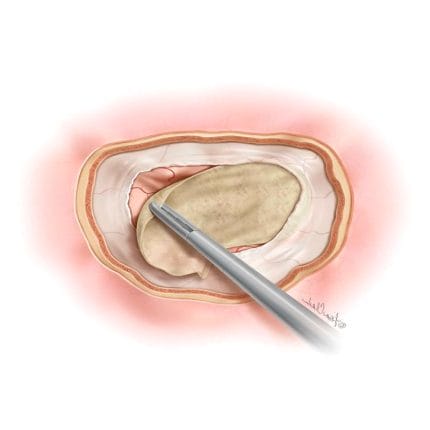 Porcine Small Intestinal Submucosa Dural Substitute