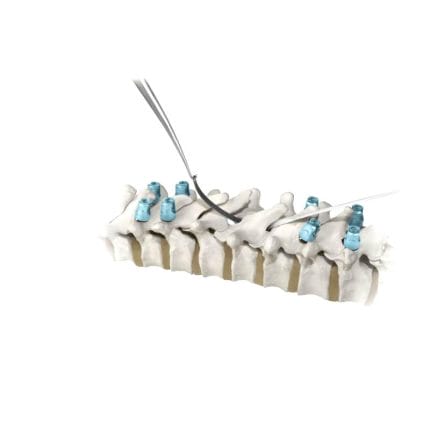 Posterior Spinal Fixation Band 1