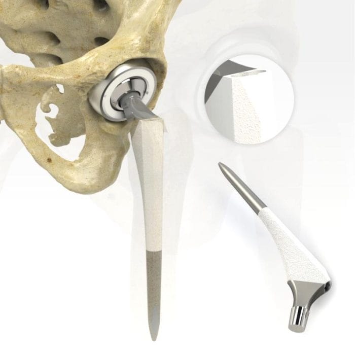 Primary Hip Prosthesis