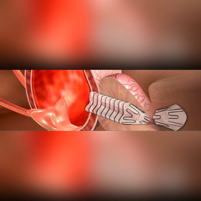 Prostatic Stent 2