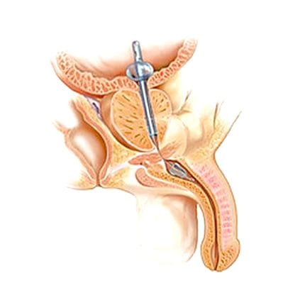 Prostatic Stent 1