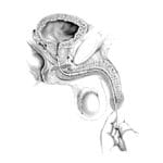 Prostatic Stent 4