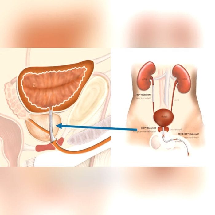 Prostatic Stent 1