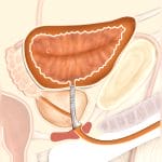 Prostatic Stent