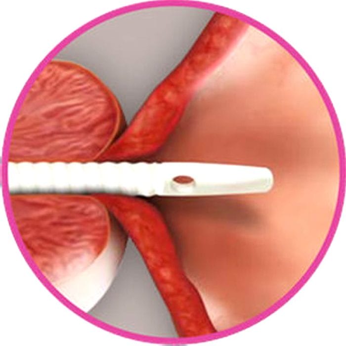 Prostatic Stent 1