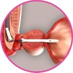 Prostatic Stent 2