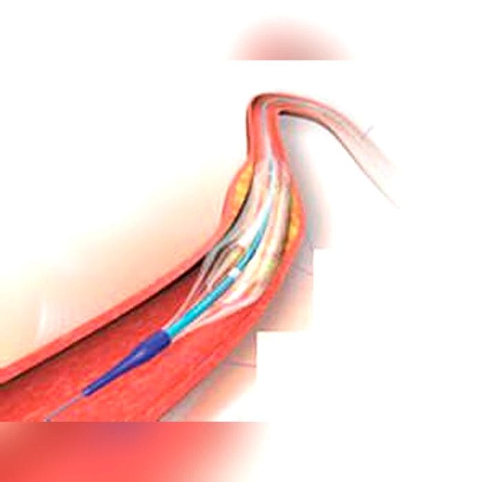 Ptca Catheter 1