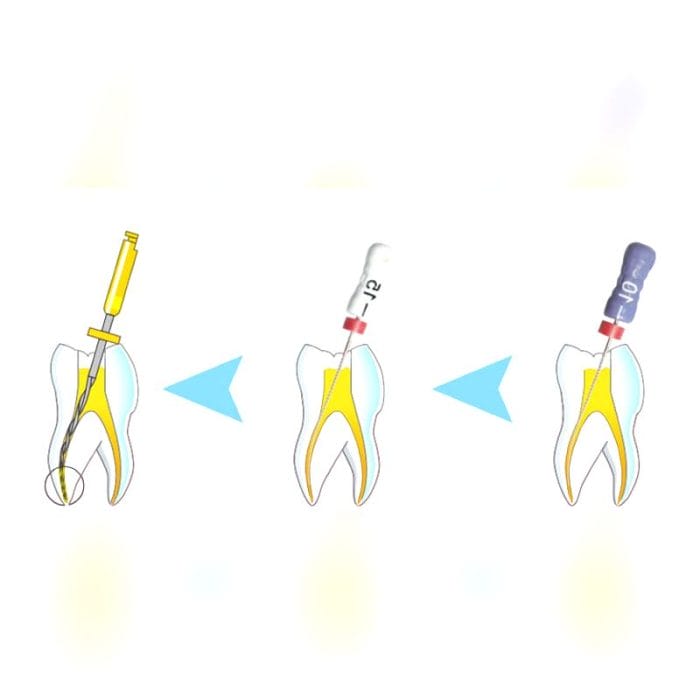 Reciprocating Endodontic File 4