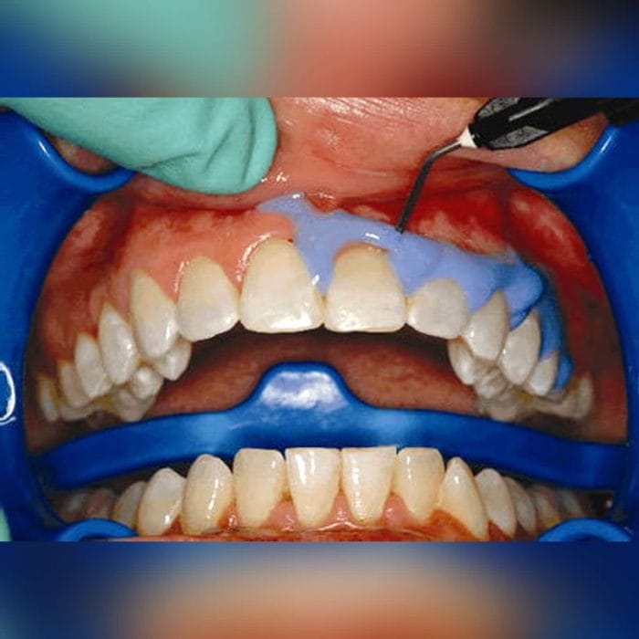 Resin Dental Material 2