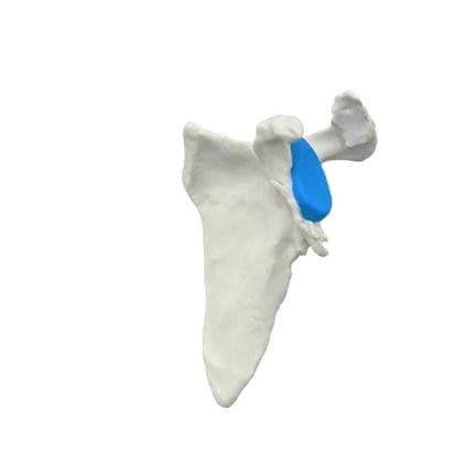 Reverse Glenoid Cavity Prosthesis 1