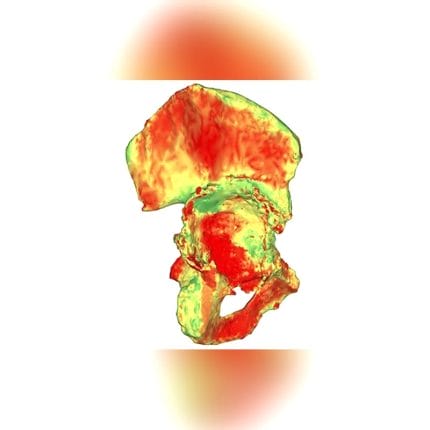 Revision Glenoid Cavity Prosthesis 1