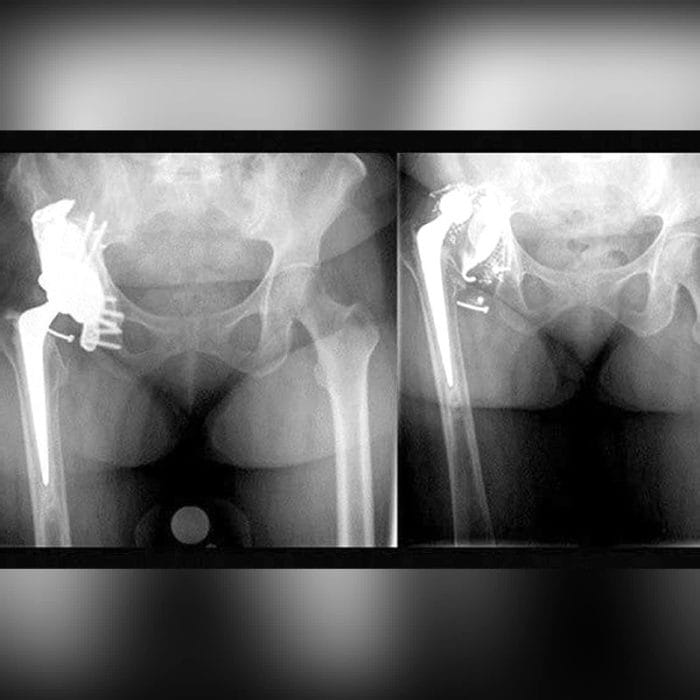 Revision Glenoid Cavity Prosthesis 2