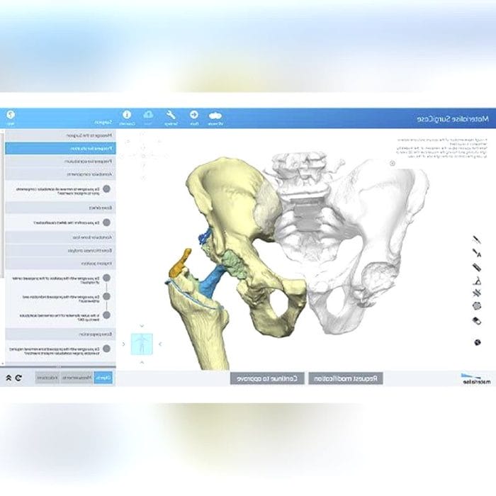 Revision Glenoid Cavity Prosthesis 5