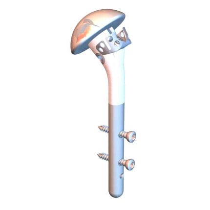 Revision Humeral Stem