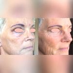 Rf Skin Rejuvenation Unit 1