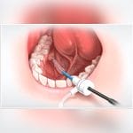 Salivary Stone Extraction Endoscopic Basket 2