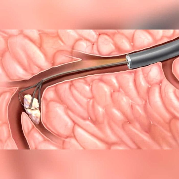 Salivary Stone Extraction Endoscopic Basket 5