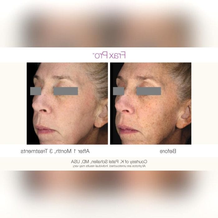 Scar Removal Laser 5