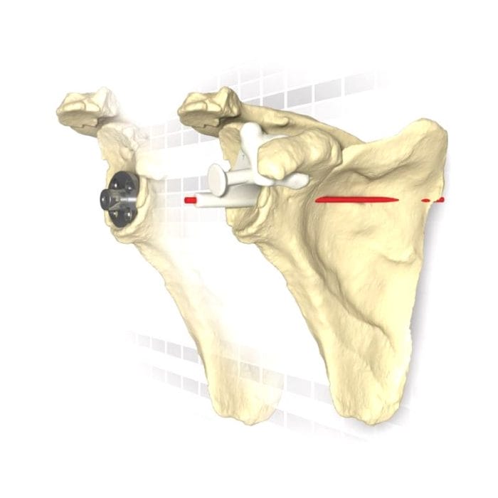 Shoulder Prosthesis Resection Guide 2