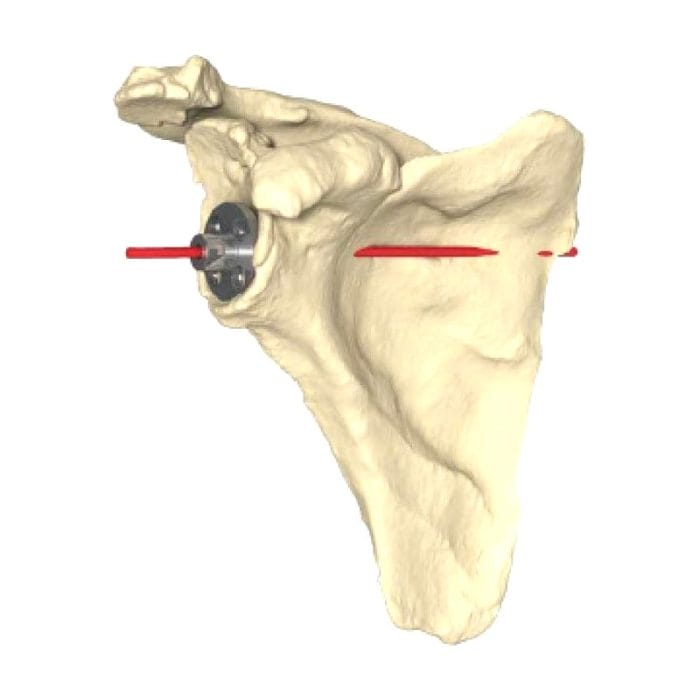 Shoulder Prosthesis Resection Guide 3