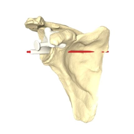 Shoulder Prosthesis Resection Guide