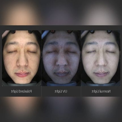 Skin Pigmentation Skin Analysis System 1