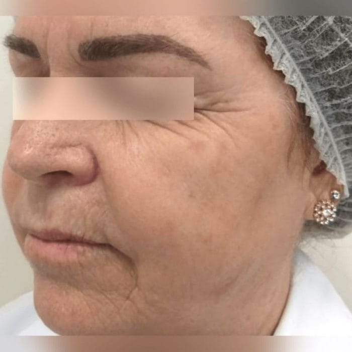 Skin Rejuvenation Laser 3