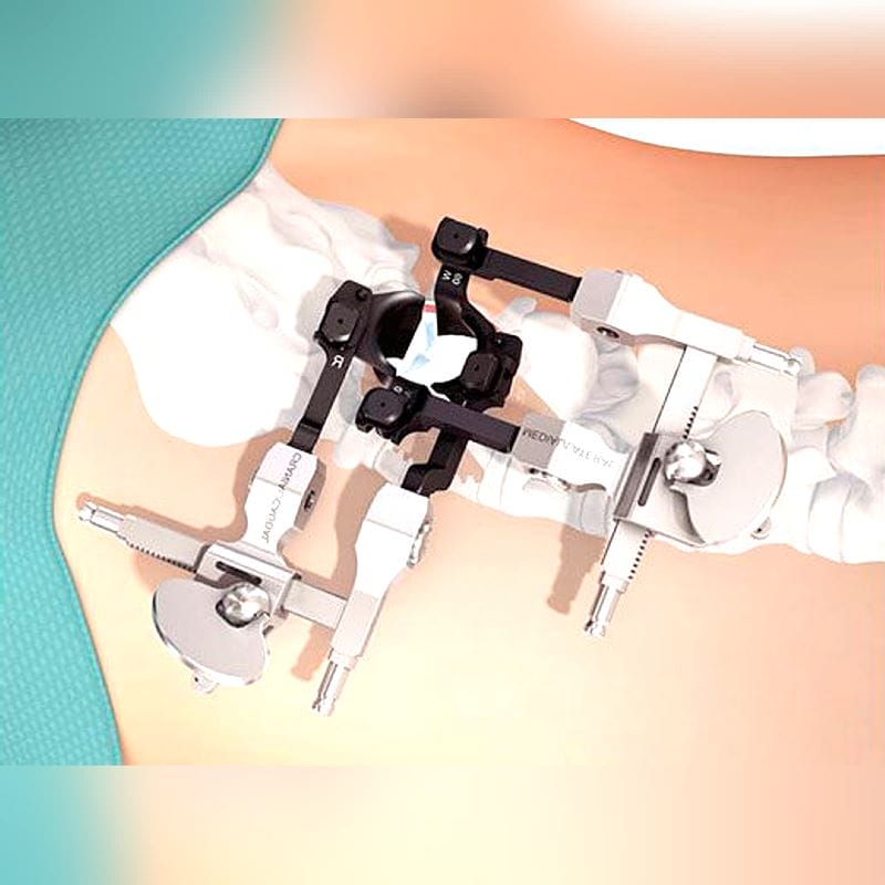 Spinal Retractor