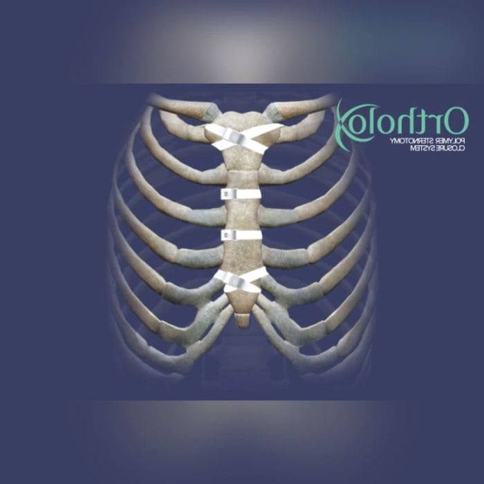 Sternal Closure Bone Cerclage Wiring 1