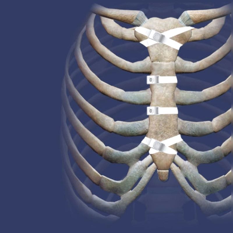 Sternal Closure Bone Cerclage Wiring