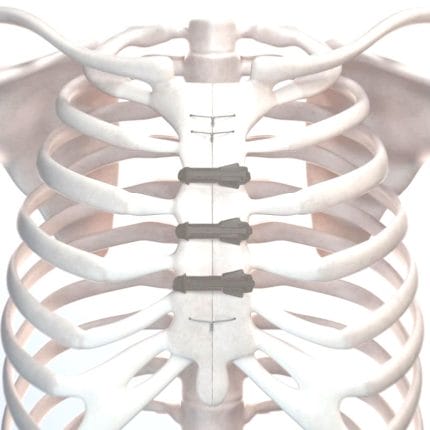 Sternal Closure Bone Cerclage Wiring