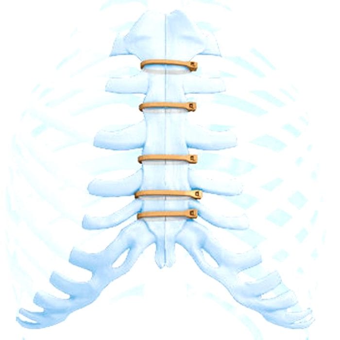 Sternal Closure Bone Cerclage Wiring