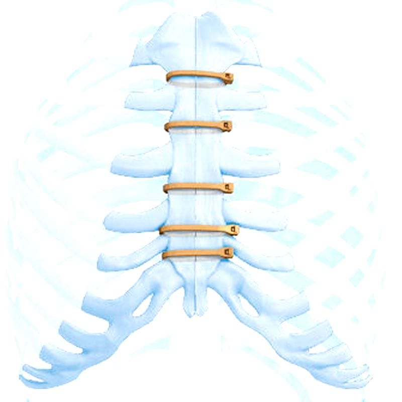 Sternal Closure Bone Cerclage Wiring