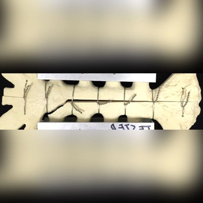 Sternal Closure Bone Cerclage Wiring 3