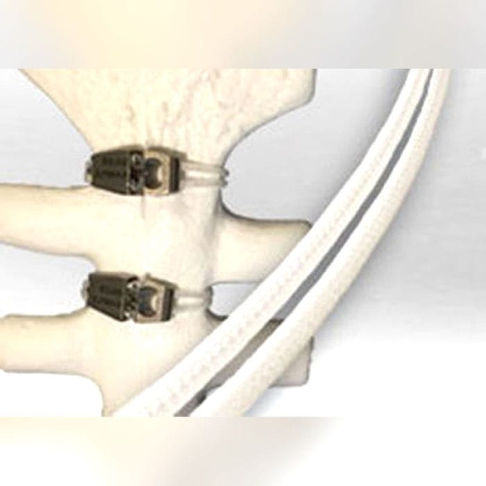 Sternal Closure Bone Cerclage Wiring