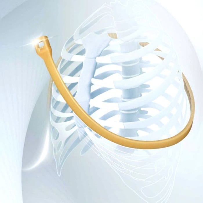 Sternal Closure Bone Cerclage Wiring