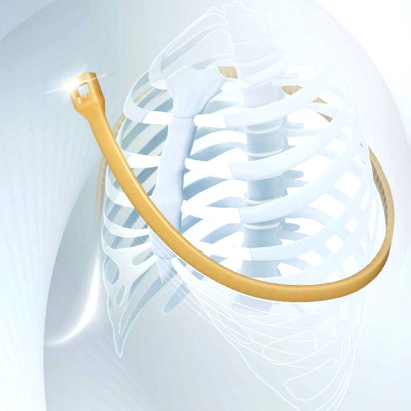 Sternal Closure Bone Cerclage Wiring