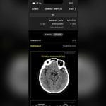 Stroke Diagnosis Mobile Application 1