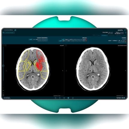 Stroke Diagnosis Software