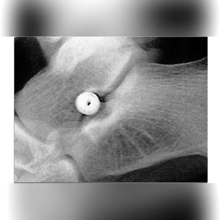 Subtalar Joint Implant 4