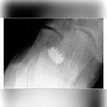 Subtalar Joint Implant 5