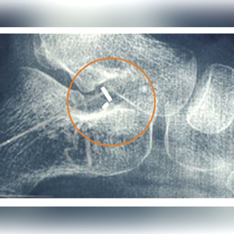 Subtalar Joint Implant 1